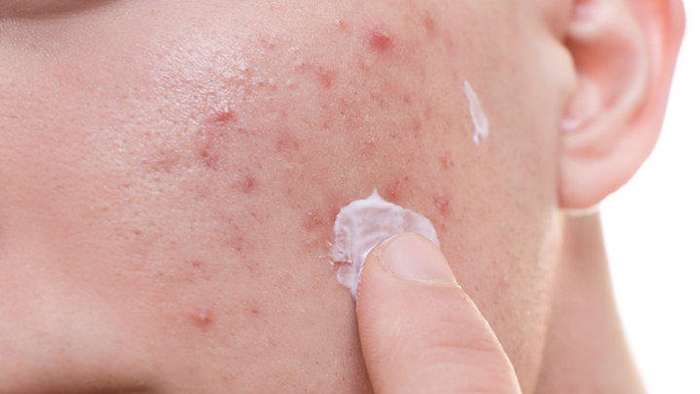 Chọn kem dưỡng chứa các chất gây dị ứng sẽ gây ra những tác động tiêu cực khiến làn da bị tổn thương